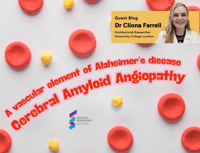 Blog – A vascular element of Alzheimer’s: Cerebral Amyloid Angiopathy